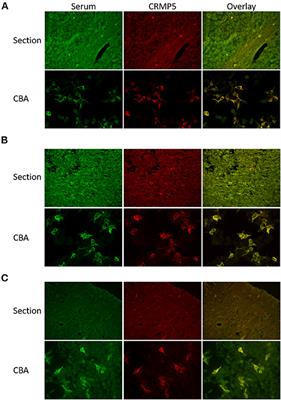 CRMP5 Antibodies—Diagnostic Challenges